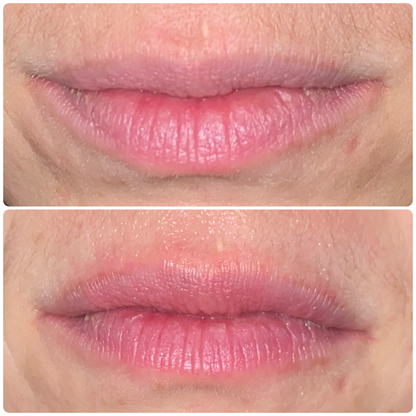 Diamondstick Hyaluron Filler