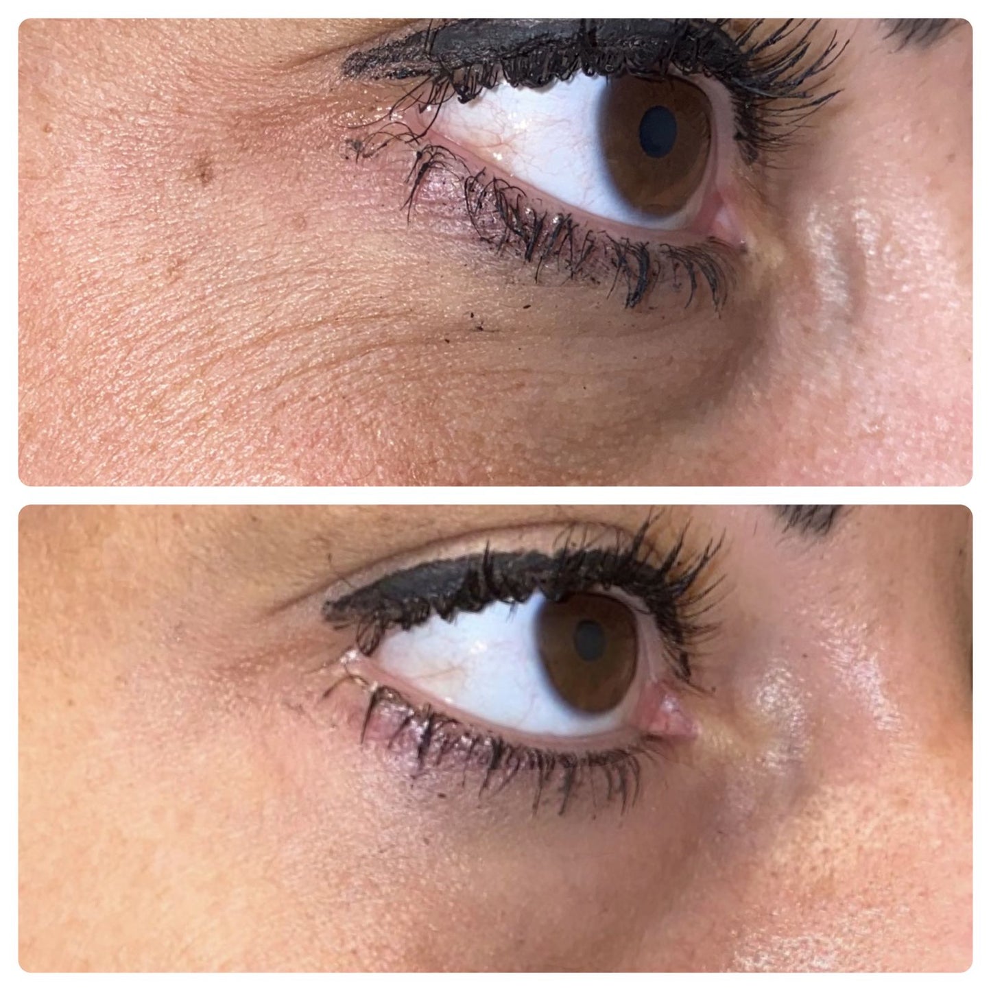 Diamondstick Hyaluron Filler