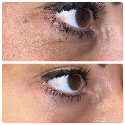 Diamondstick Hyaluron Filler